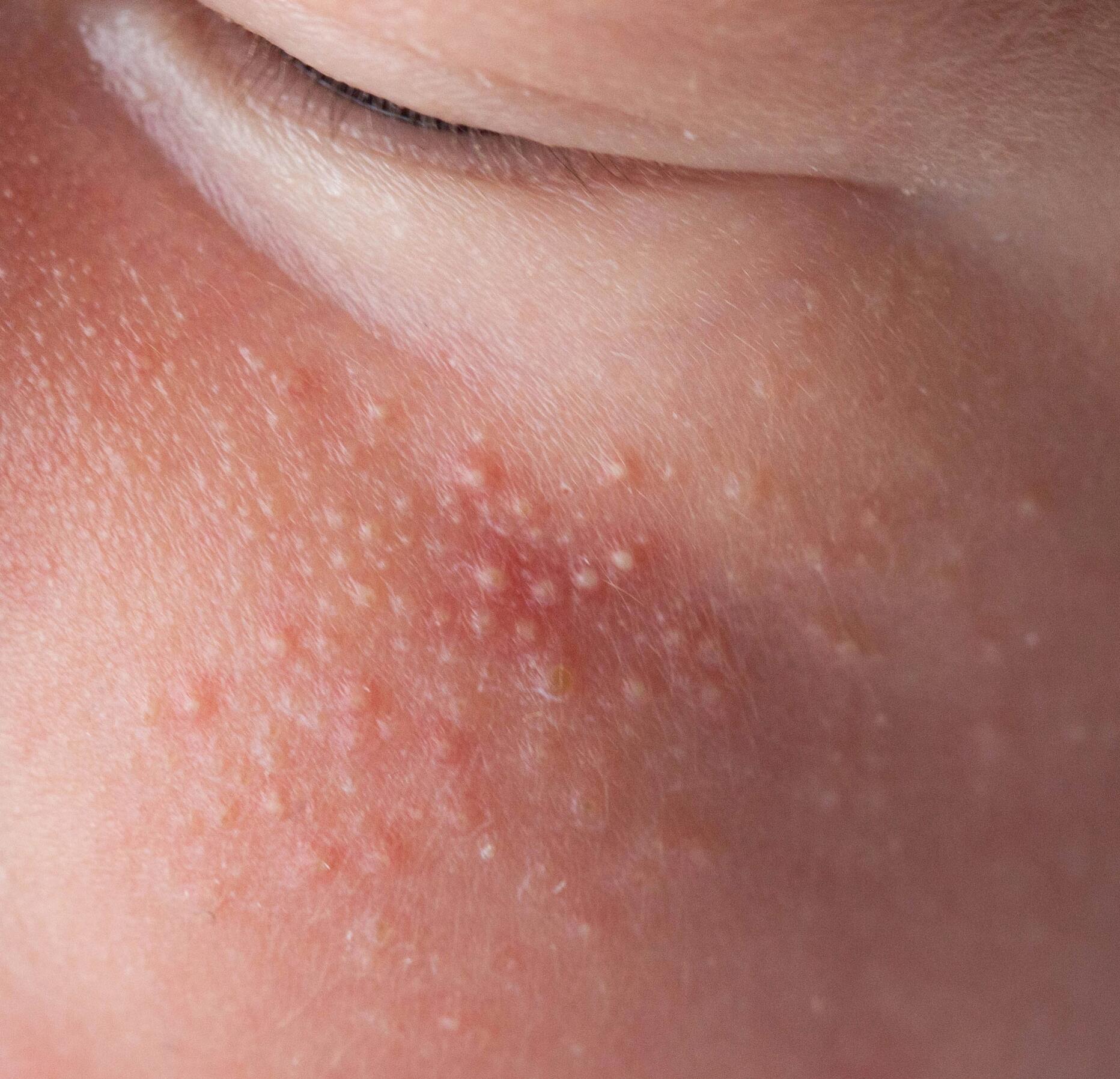 Acne in infants